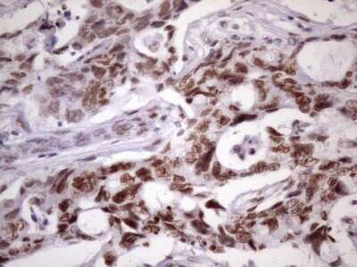 Immunohistochemistry: NUDT21 Antibody (OTI13H1) [NBP2-46276] -  Analysis of Adenocarcinoma of Human breast tissue. (Heat-induced epitope retrieval by 1 mM EDTA in 10mM Tris, pH8.5, 120 degrees C for 3min)