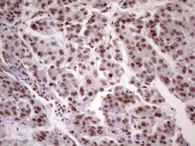 Immunohistochemistry: NUDT21 Antibody (OTI13H1) [NBP2-46276] - Analysis of Carcinoma of Human liver tissue. (Heat-induced epitope retrieval by 1 mM EDTA in 10mM Tris, pH8.5, 120C for 3min)