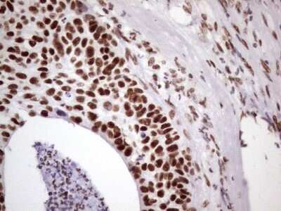 Immunohistochemistry: NUDT21 Antibody (OTI13H1) [NBP2-46276] - Analysis of Carcinoma of Human lung tissue. (Heat-induced epitope retrieval by 1 mM EDTA in 10mM Tris, pH8.5, 120C for 3min)