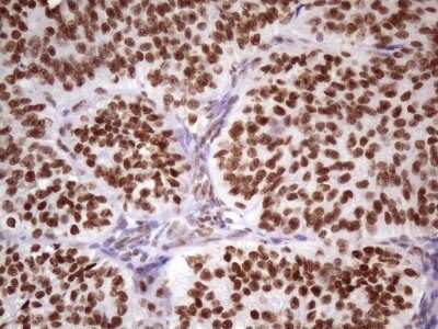 Immunohistochemistry: NUDT21 Antibody (OTI13H1) [NBP2-46276] - Analysis of Adenocarcinoma of Human ovary tissue. (Heat-induced epitope retrieval by 1 mM EDTA in 10mM Tris, pH8.5, 120C for 3min)