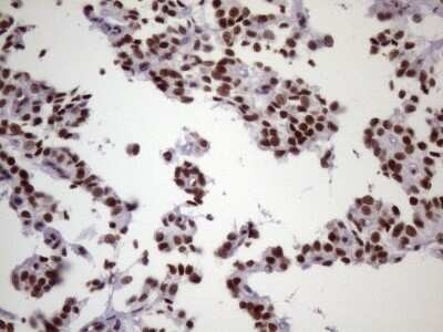 Immunohistochemistry: NUDT21 Antibody (OTI13H1) [NBP2-46276] - Analysis of Carcinoma of Human pancreas tissue. (Heat-induced epitope retrieval by 1 mM EDTA in 10mM Tris, pH8.5, 120C for 3min)