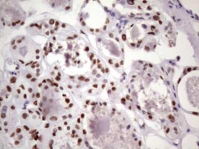 Immunohistochemistry: NUDT21 Antibody (OTI13H1) [NBP2-46276] - Analysis of Carcinoma of Human thyroid tissue. (Heat-induced epitope retrieval by 1 mM EDTA in 10mM Tris, pH8.5, 120C for 3min)