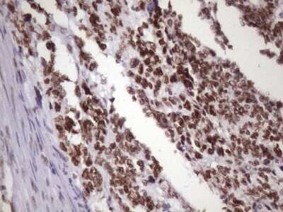 Immunohistochemistry: NUDT21 Antibody (OTI13H1) [NBP2-46276] - Analysis of Adenocarcinoma of Human endometrium tissue. (Heat-induced epitope retrieval by 1 mM EDTA in 10mM Tris, pH8.5, 120C for 3min)