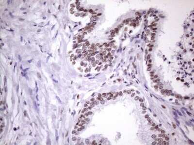 Immunohistochemistry: NUDT21 Antibody (OTI13H1) [NBP2-46276] - Analysis of Carcinoma of Human prostate tissue. (Heat-induced epitope retrieval by 1 mM EDTA in 10mM Tris, pH8.5, 120C for 3min)