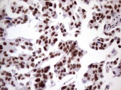 Immunohistochemistry: NUDT21 Antibody (OTI13H1) [NBP2-46276] - Analysis of Carcinoma of Human bladder tissue. (Heat-induced epitope retrieval by 1 mM EDTA in 10mM Tris, pH8.5, 120C for 3min)