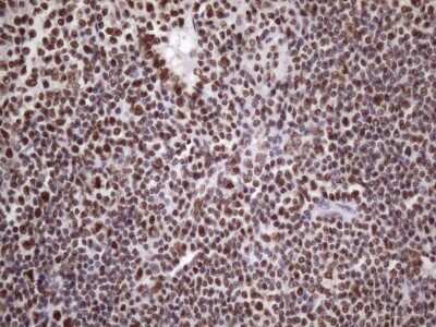 Immunohistochemistry: NUDT21 Antibody (OTI13H1) [NBP2-46276] - Analysis of Human lymphoma tissue. (Heat-induced epitope retrieval by 1 mM EDTA in 10mM Tris, pH8.5, 120C for 3min)