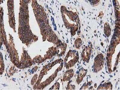 Immunohistochemistry-Paraffin: NUDT6 Antibody (9D12) [NBP2-03554] - Staining of paraffin-embedded Carcinoma of Human prostate tissue using anti-NUDT6 mouse monoclonal antibody.