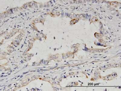 Immunohistochemistry-Paraffin: NUP50 Antibody [H00010762-B01P] - Analysis of purified antibody to NUP50 on formalin-fixed paraffin-embedded human pancreatic cancer. (antibody concentration 1.5 ug/ml)