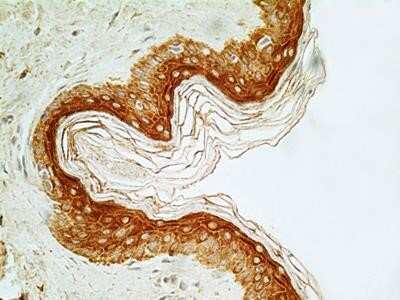 Immunocytochemistry: NUT Antibody (2B6) - Azide and BSA Free [NBP2-80887] - IHC-P analysis of NUT protein in normal human skin tissue section using NUT antibody (clone 46B4G9.2B6) at a concentration of 5 ug/ml. This antibody stained the nuclei and cytoplasm of different epidermal cell types such as granulosa cells, keratinocytes,