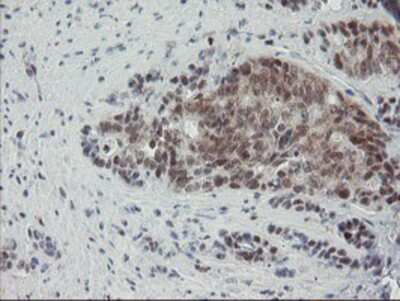 Immunohistochemistry-Paraffin: NYREN18 Antibody (4H2) [NBP2-03897] - Staining of paraffin-embedded Carcinoma of Human pancreas tissue using anti-NYREN18 mouse monoclonal antibody.