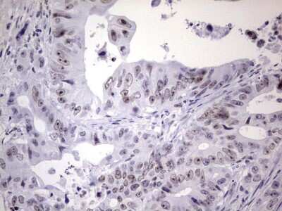 Immunohistochemistry: Nab2 Antibody (5D7) [NBP2-46080] - Analysis of Adenocarcinoma of Human colon tissue. (Heat-induced epitope retrieval by 1 mM EDTA in 10mM Tris, pH8.5, 120C for 3min)