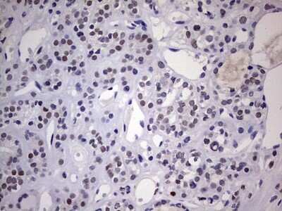 Immunohistochemistry: Nab2 Antibody (5D7) [NBP2-46080] - Analysis of Carcinoma of Human thyroid tissue. (Heat-induced epitope retrieval by 1 mM EDTA in 10mM Tris, pH8.5, 120C for 3min)