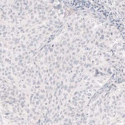 Immunohistochemistry-Paraffin: Nanog Antibody (CL5803) [NBP2-61428] - Staining of human bladder cancer shows absence of positivity in tumor cells as expected (negative control).