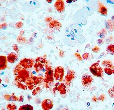 Immunohistochemistry-Paraffin: Napsin A Antibody (KCG1.1) [NB110-90605] - Formalin fixed paraffin embedded human lung adenocarcinoma stained with Napsin A monoclonal antibody.