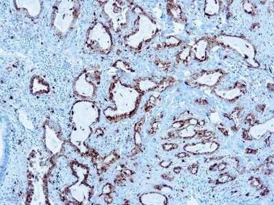Immunohistochemistry-Paraffin: Napsin A Antibody (KCG1.1) [NB110-90605] - Formalin fixed paraffin embedded human Lung adenocarcinoma stained with Napsin A antibody (NB110-90605).