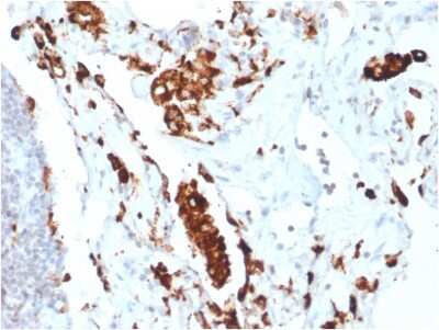 Immunohistochemistry-Paraffin: Napsin A Antibody (NAPSA/1865R) - Azide and BSA Free [NBP3-08379] - Formalin-fixed, paraffin-embedded human Lung Adenocarcinoma stained with Napsin A Rabbit Recombinant Monoclonal Antibody (NAPSA/1865R).