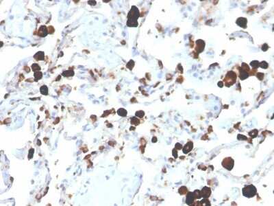 Immunohistochemistry-Paraffin: Napsin A Antibody (NAPSA/3305) - Azide and BSA Free [NBP3-08375] - Formalin-fixed, paraffin-embedded human lung adenocarcinoma stained with Napsin A Mouse Monoclonal Antibody (NAPSA/3305).