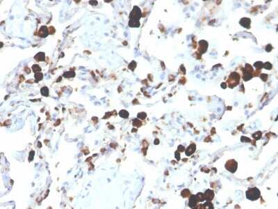 Immunohistochemistry-Paraffin: Napsin A Antibody (NAPSA/3305) [NBP3-07866] - Formalin-fixed, paraffin-embedded human lung adenocarcinoma stained with Napsin A Mouse Monoclonal Antibody (NAPSA/3305).