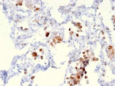Immunohistochemistry-Paraffin: Napsin A Antibody (NAPSA/3306) [NBP3-08376] - Formalin-fixed, paraffin-embedded human Lung Adenocarcinoma stained with Napsin A Mouse Monoclonal Antibody (NAPSA/3306).