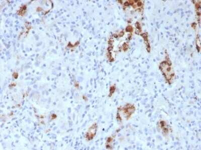 Immunohistochemistry-Paraffin: Napsin A Antibody (NAPSA/3307) [NBP3-08377] - Formalin-fixed, paraffin-embedded human Lung Adenocarcinoma stained with Napsin A Mouse Monoclonal Antibody (NAPSA/3307).