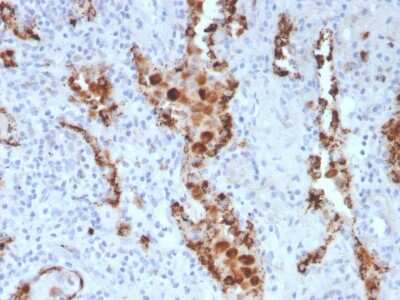 Immunohistochemistry-Paraffin: Napsin A Antibody (NAPSA/3307) [NBP3-08377] - Formalin-fixed, paraffin-embedded human Lung Adenocarcinoma stained with Napsin A Mouse Monoclonal Antibody (NAPSA/3307).