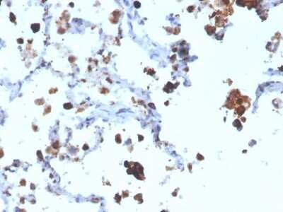 Immunohistochemistry-Paraffin: Napsin A Antibody (NAPSA/3308) - Azide and BSA Free [NBP3-08368] - Formalin-fixed, paraffin-embedded human Lung Adenocarcinoma stained with Napsin A Mouse Monoclonal Antibody (NAPSA/3308).