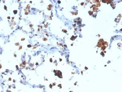 Immunohistochemistry-Paraffin: Napsin A Antibody (NAPSA/3308) [NBP3-07862] - Formalin-fixed, paraffin-embedded human Lung Adenocarcinoma stained with Napsin A Mouse Monoclonal Antibody (NAPSA/3308).