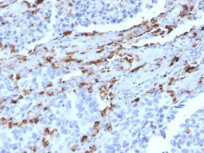 Immunohistochemistry-Paraffin: Napsin A Antibody (NAPSA/3309) [NBP3-07863] - Formalin-fixed, paraffin-embedded human Lung Adenocarcinoma stained with Napsin A Mouse Monoclonal Antibody (NAPSA/3309).