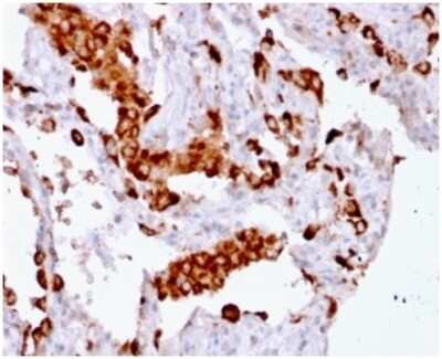 Immunohistochemistry-Paraffin: Napsin A Antibody (rNAPSA/1239) - Azide and BSA Free [NBP3-08374] - Formalin-fixed, paraffin-embedded human Lung Adenocarcinoma stained with Napsin A Mouse Recombinant Monoclonal Antibody (rNAPSA/1239).