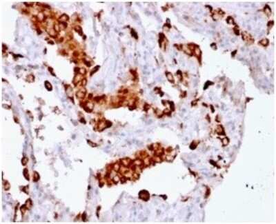 Immunohistochemistry-Paraffin: Napsin A Antibody (rNAPSA/1239) [NBP3-07865] - Formalin-fixed, paraffin-embedded human Lung Adenocarcinoma stained with Napsin A Mouse Recombinant Monoclonal Antibody (rNAPSA/1239).