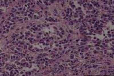 Hematoxylin & Eosin Stain: Nasal Cavity Olfactory Neuroblastoma Tissue Slides [NBP2-30288] -  nasal cavity, olfactory neuroblastoma  Age/Sex : 26/M