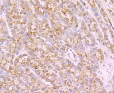 Immunohistochemistry-Paraffin: Nav1.7 Antibody [NBP2-75581] - Analysis of paraffin-embedded human liver cancer tissue using anti-NaV1.7 beta antibody. Counter stained with hematoxylin.