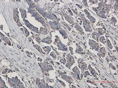 Immunohistochemistry-Paraffin: Ndufs1 Antibody (S02-3I2) [NBP3-19894] - Immunohistochemistry of Ndufs1 in paraffin-embedded Human Cholangiocarcinoma using NBP3-19894 at dilution 1/50