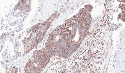 Immunohistochemistry-Paraffin: Ndufs4 Antibody [NBP1-31465] -  Human ovarian cancer, using NDUFS4 antibody at 1:100 dilution.  Antigen Retrieval: Trilogy™ (EDTA based, pH 8.0) buffer, 15min.