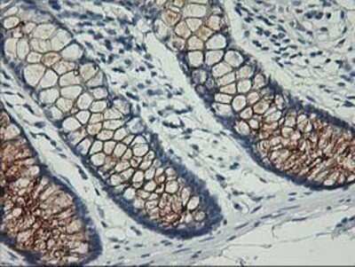 Immunohistochemistry: Nectin-1/PVRL1 Antibody (OTI6F8) - Azide and BSA Free [NBP2-72929] - Staining of paraffin-embedded Adenocarcinoma of Human ovary tissue using anti-PVRL1 mouse monoclonal antibody.
