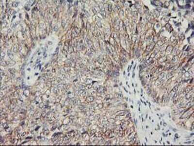 Immunohistochemistry: Nectin-1/PVRL1 Antibody (OTI6F8) - Azide and BSA Free [NBP2-72929] - Staining of paraffin-embedded Carcinoma of Human bladder tissue using anti-PVRL1 mouse monoclonal antibody.