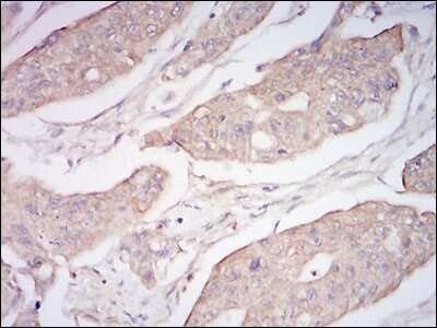Immunohistochemistry: Neprilysin/CD10 Antibody (5E9A5) [NBP2-37301] - Immunohistochemical analysis of paraffin-embedded rectum cancer tissues using CD10 mouse mAb with DAB staining.