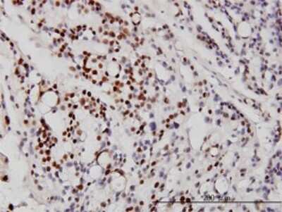 Immunohistochemistry-Paraffin: NeuroD1 Antibody (3H8) [H00004760-M01] - Analysis of monoclonal antibody to NEUROD1 on formalin-fixed paraffin-embedded human ovary, clear cell carcinoma. Antibody concentration 3 ug/ml.