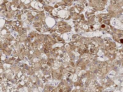 Immunohistochemistry-Paraffin: NeuroD1 Antibody [NBP2-98697] - Immunochemical staining of human NeuroD1 in human hepatoma with rabbit polyclonal antibody (1:2000, formalin-fixed paraffin embedded sections).