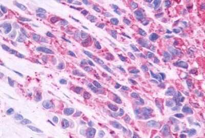 Immunohistochemistry-Paraffin: Neuromedin B R/NMBR Antibody [NLS828] - Anti-NMBR antibody IHC of human Skin, Melanoma. Immunohistochemistry of formalin-fixed, paraffin-embedded tissue after heat-induced antigen retrieval.