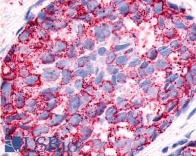 Immunohistochemistry-Paraffin: Neuropeptide FF R1/NPFFR1 Antibody [NLS1903] - Anti-NPFFR1 / GPR147 antibody IHC of human Breast, Carcinoma. Immunohistochemistry of formalin-fixed, paraffin-embedded tissue after heat-induced antigen retrieval.