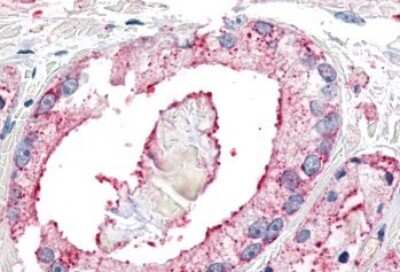 Immunohistochemistry-Paraffin: Neuropeptide FF R1/NPFFR1 Antibody [NLS1903] - Anti-NPFFR1 / GPR147 antibody IHC of human Prostate, Carcinoma. Immunohistochemistry of formalin-fixed, paraffin-embedded tissue after heat-induced antigen retrieval.