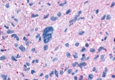 Immunohistochemistry-Paraffin: Neuropeptide FF R1/NPFFR1 Antibody [NLS1903] - Anti-NPFFR1 / GPR147 antibody IHC of human Brain, Glioblastoma. Immunohistochemistry of formalin-fixed, paraffin-embedded tissue after heat-induced antigen retrieval.