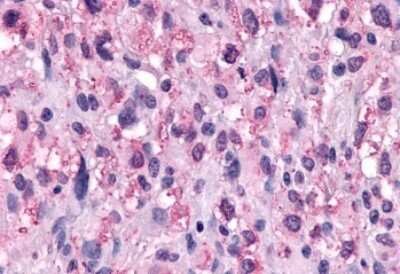 Immunohistochemistry-Paraffin: Neuropeptide FF R1/NPFFR1 Antibody [NLS1905] - Anti-NPFFR1 / GPR147 antibody IHC of human Brain, Glioblastoma. Immunohistochemistry of formalin-fixed, paraffin-embedded tissue after heat-induced antigen retrieval.
