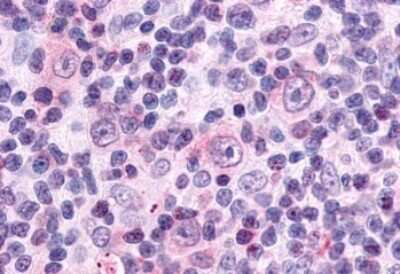 Immunohistochemistry-Paraffin: Neuropeptide FF R1/NPFFR1 Antibody [NLS1905] - Anti-NPFFR1 / GPR147 antibody IHC of human Lymph Node, Hodgkins Lymphoma. Immunohistochemistry of formalin-fixed, paraffin-embedded tissue after heat-induced antigen retrieval.