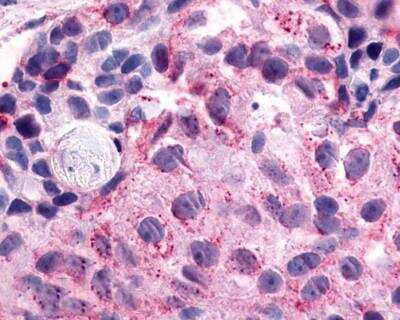 Immunohistochemistry-Paraffin: Neuropeptide FF R1/NPFFR1 Antibody [NLS1905] - Anti-NPFFR1 / GPR147 antibody IHC of human Breast, Carcinoma. Immunohistochemistry of formalin-fixed, paraffin-embedded tissue after heat-induced antigen retrieval.