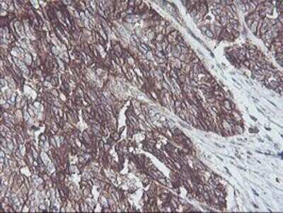 Immunohistochemistry: Neuroplastin Antibody (OTI3C4) - Azide and BSA Free [NBP2-72966] - Staining of paraffin-embedded Adenocarcinoma of Human ovary tissue using anti-NPTN mouse monoclonal antibody.