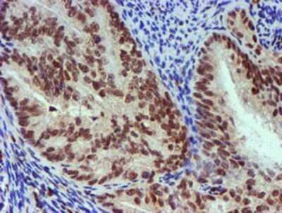 Immunohistochemistry: Nicotinamide N-Methyltransferase/NNMT Antibody (OTI3D8) - Azide and BSA Free [NBP2-72984] - Staining of paraffin-embedded Adenocarcinoma of Human endometrium tissue using anti-NNMT mouse monoclonal antibody.