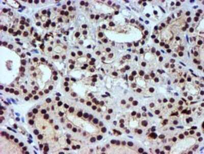 Immunohistochemistry: Nicotinamide N-Methyltransferase/NNMT Antibody (OTI3D8) - Azide and BSA Free [NBP2-72984] - Staining of paraffin-embedded Carcinoma of Human thyroid tissue using anti-NNMT mouse monoclonal antibody.