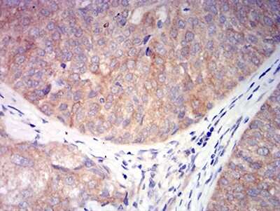 Immunohistochemistry: Nicotinic Acetylcholine R alpha 6/CHRNA6 Antibody (5B6G8) [NBP2-61679] - Analysis of paraffin-embedded bladder cancer tissues using CHRNA6 mouse mAb with DAB staining.